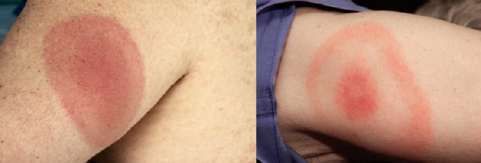 Symptoms of Lyme disease. The rash can look like a bull's-eye on a dartboard or the skin will be red and the edges may feel slightly raised